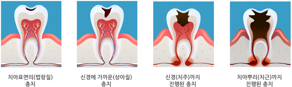 충치의 진행 단계를 순서대로 보여 주는 일러스트