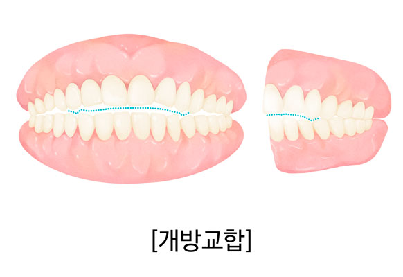 개방교합을 설명하는 치아교정 일러스트