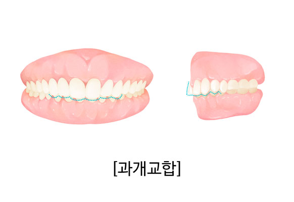 과개교합을 설명하는 치아교정 일러스트