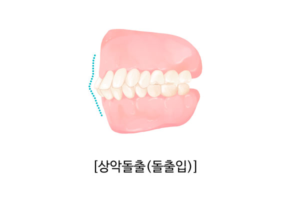 위 앞니가 앞으로 나온 돌출 일러스트