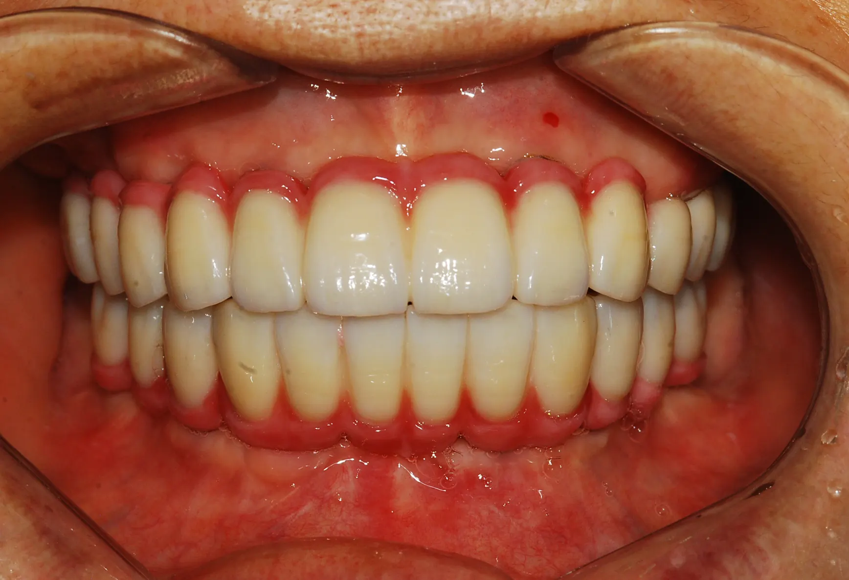 Ca implant 01, sau điều trị