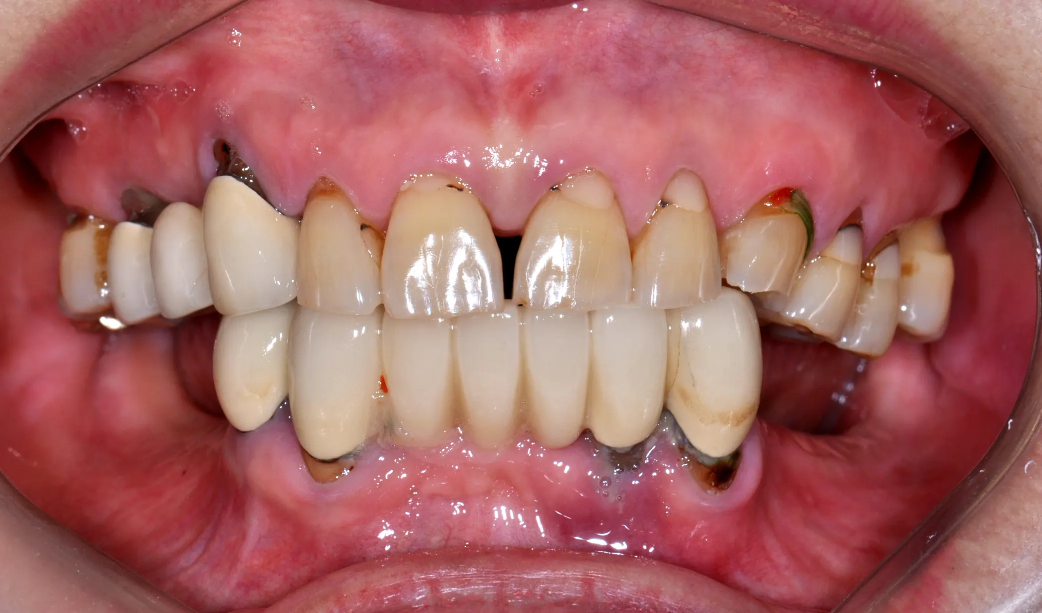 Ca implant 01, trước điều trị
