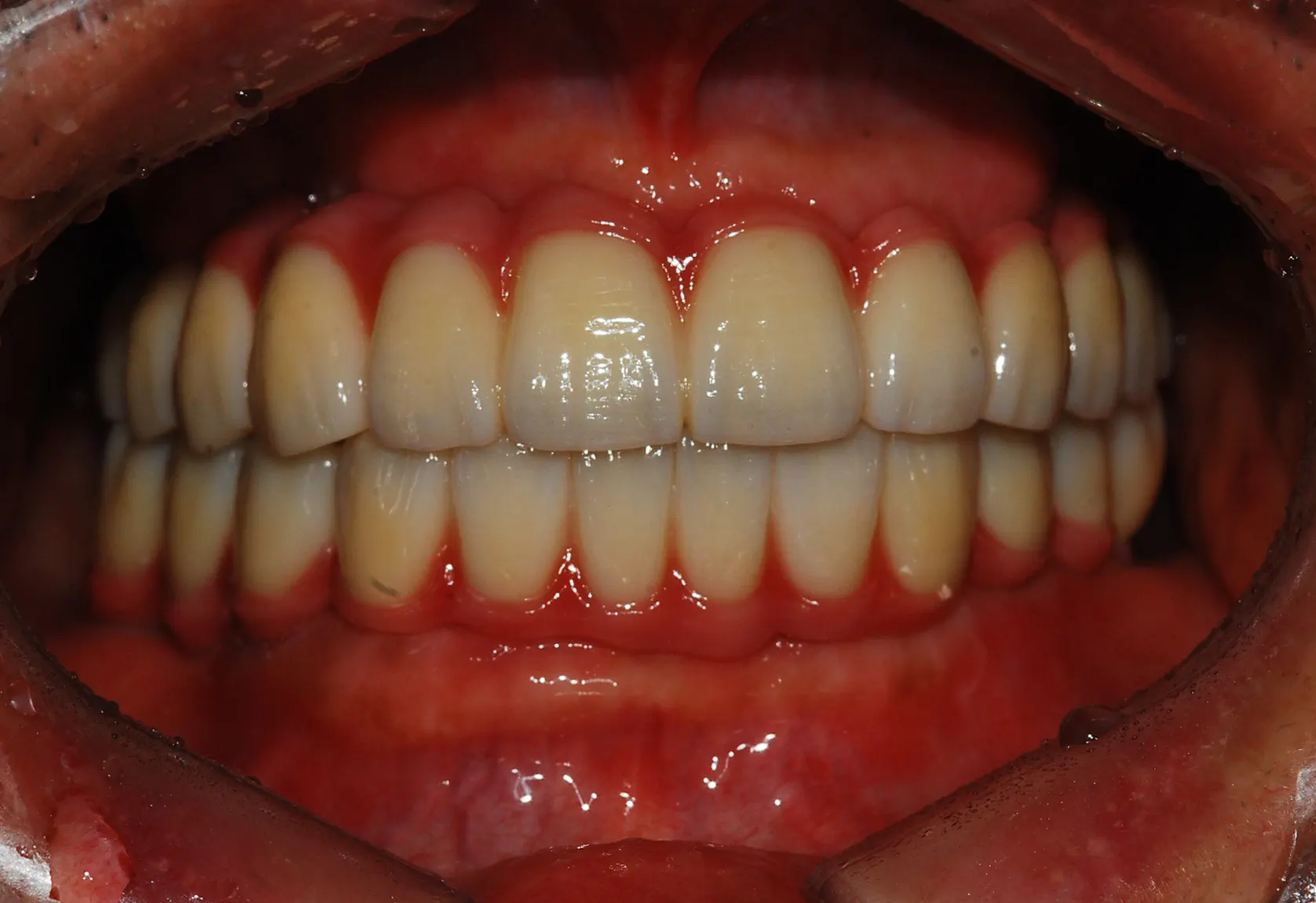 Ca implant 02, sau điều trị