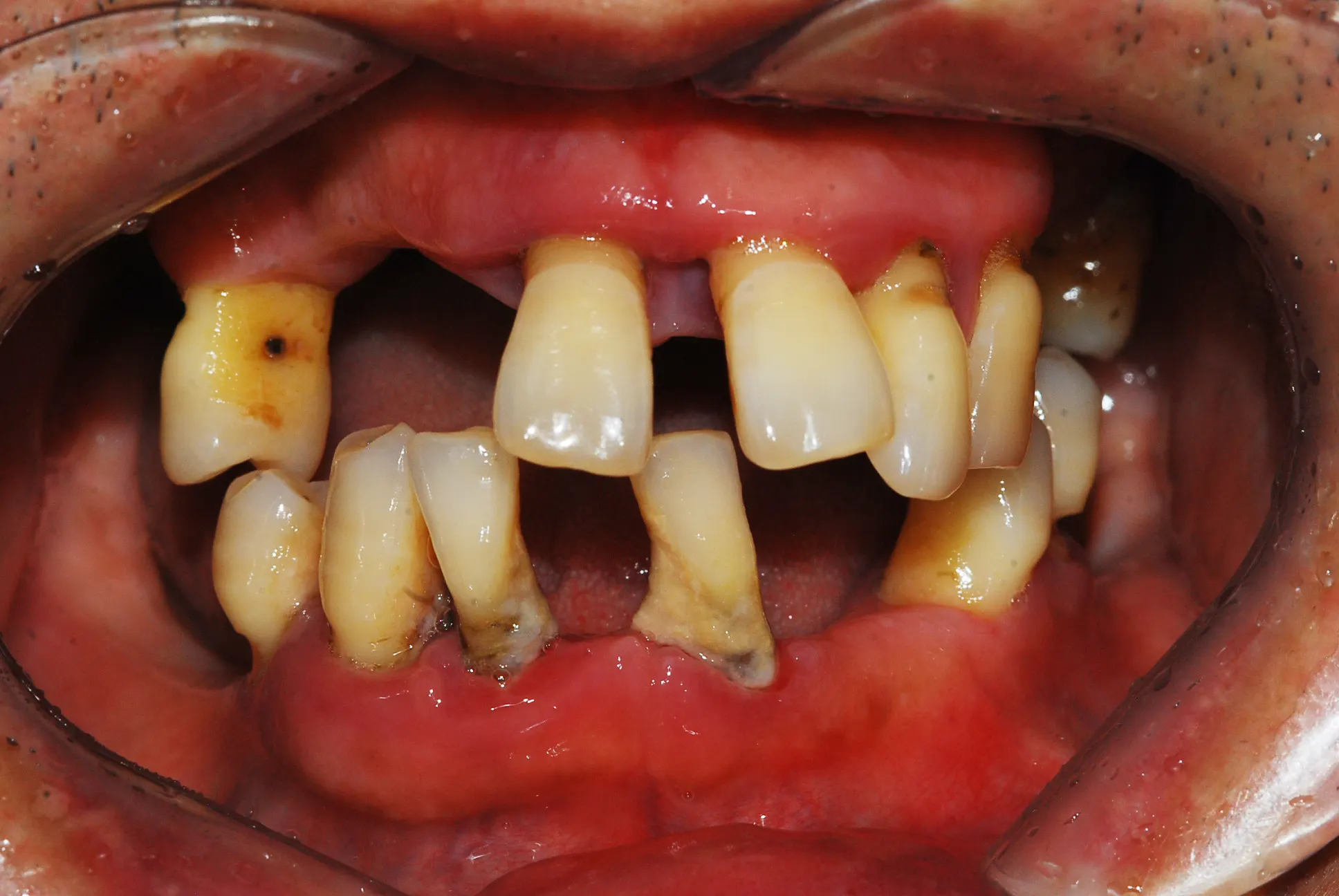 Ca implant 02, trước điều trị