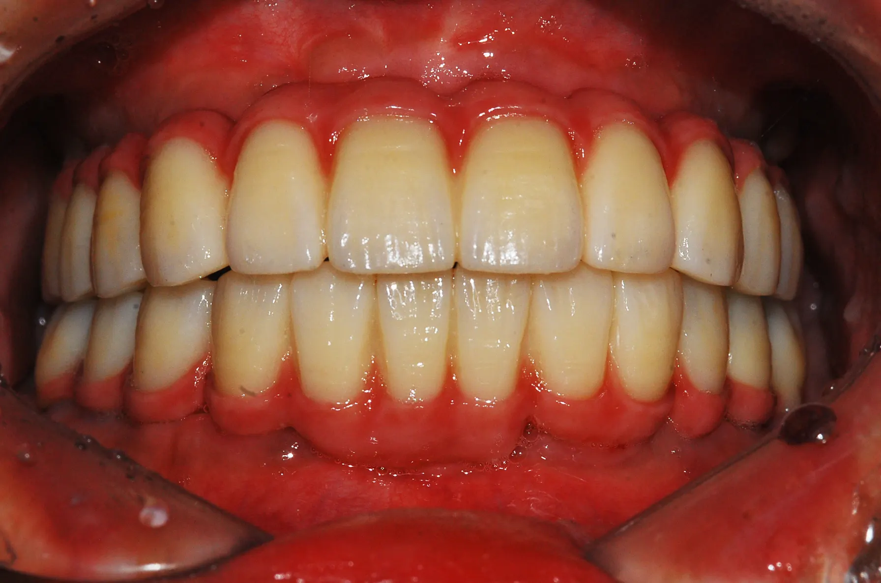 Ca implant 03, sau điều trị