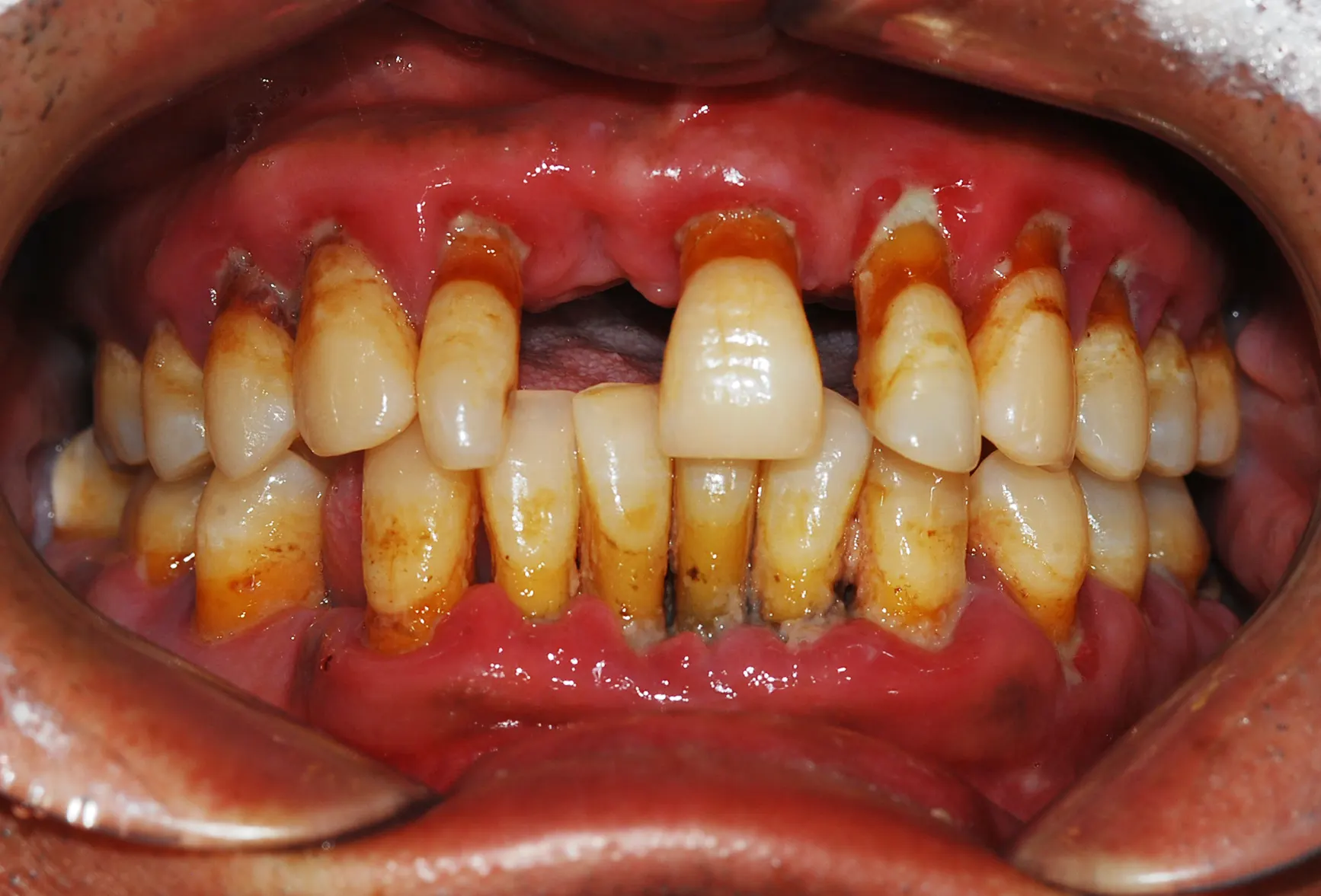 Ca implant 03, trước điều trị