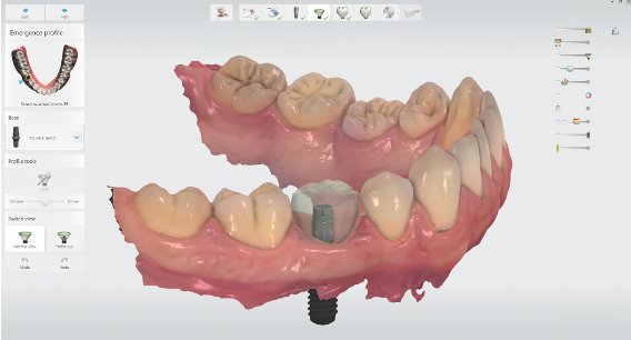 3D CT·디지털 구강스캔 임플란트 정밀 진단 화면 — 부산 뉴욕치과
